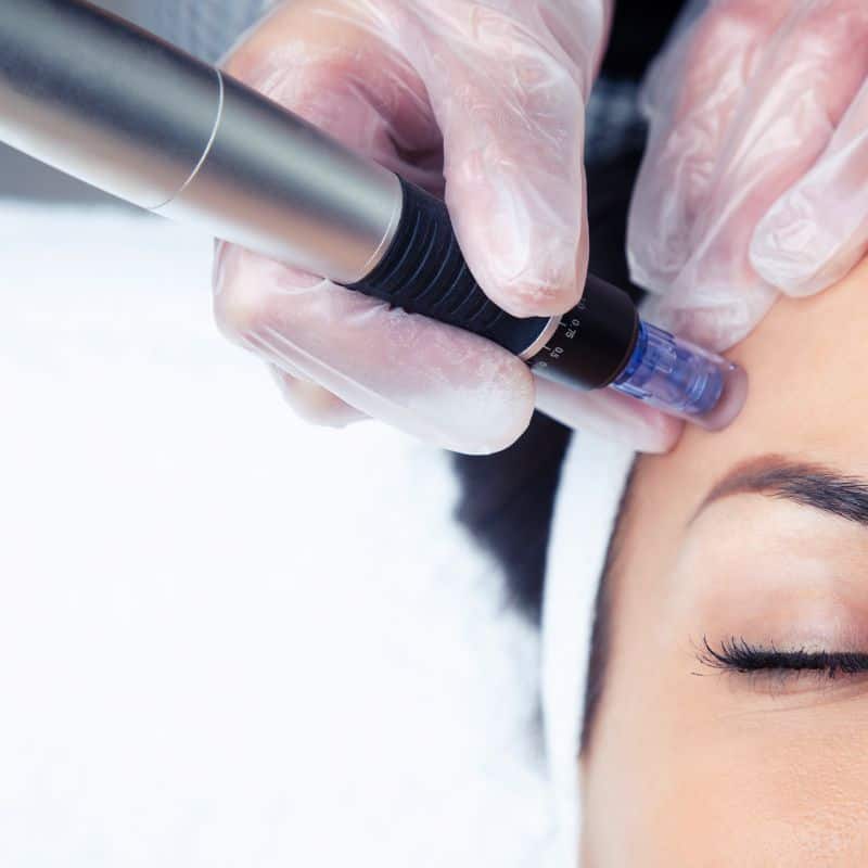 Morpheus8 treatment Redhill from Lipo Sculpt - Book in today!